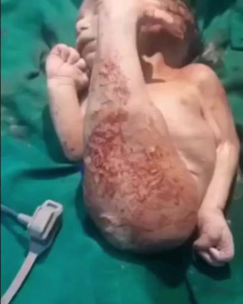 什么是美人魚綜合癥，關于美人魚綜合癥