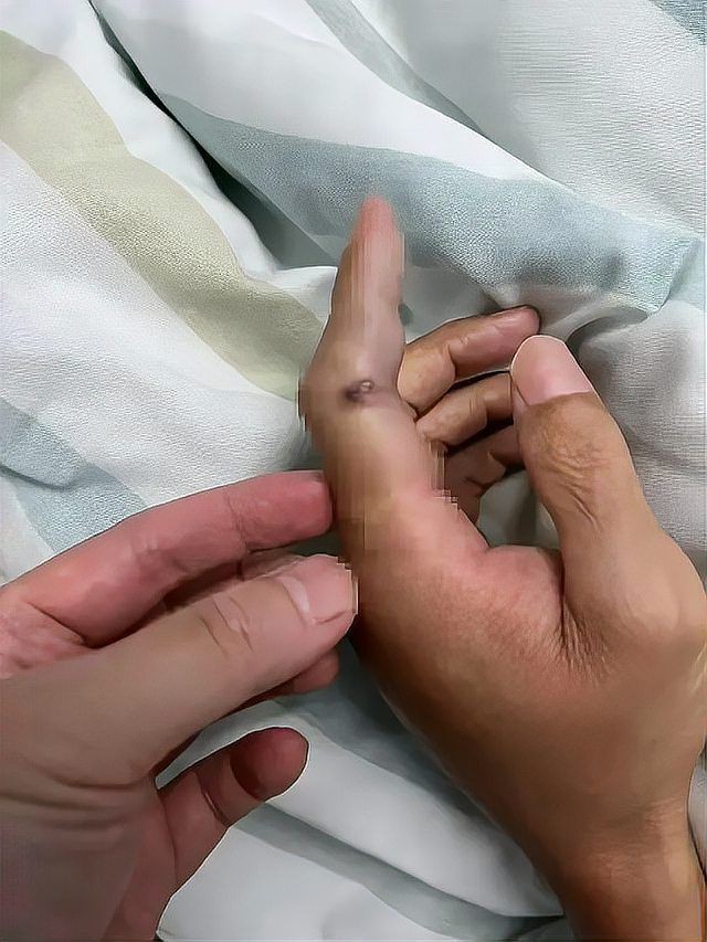 海洋弧菌感染的死亡率有多高？，光明網,創傷弧菌:海洋中的隱形殺手