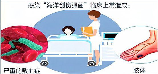 海洋弧菌感染的死亡率有多高？，光明網(wǎng),創(chuàng)傷弧菌:海洋中的隱形殺手