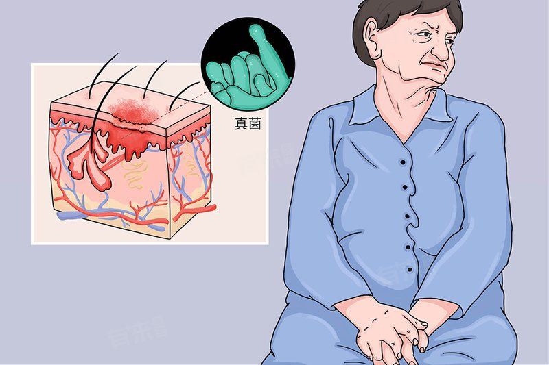 晚期真菌感染的治愈率有多高？，晚期真菌感染治愈率