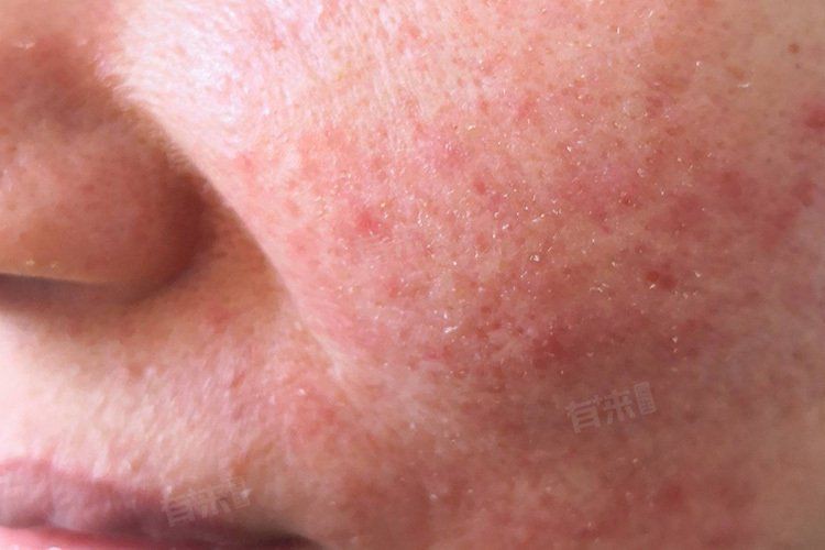 玫瑰膠囊吃了6個月臉垮了,任培華副主任醫師三甲玫瑰膠囊長期吃有副作用嗎 龍魚百科 第2張 玫瑰膠囊吃了6個月臉垮了,任培華副主任醫師三甲玫瑰膠囊長期吃有副作用嗎 玫瑰膠囊吃了6個月臉垮了,任培華副主任醫師三甲玫瑰膠囊長期吃有副作用嗎 龍魚百科 第2張