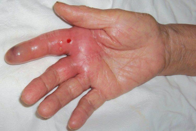 如何判斷是否感染了海洋細(xì)菌？