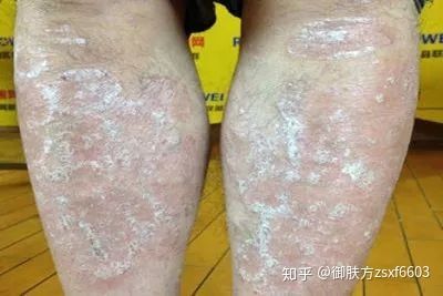 龍魚(yú)鱗上有白點(diǎn)為什么：龍魚(yú)鱗片上出現(xiàn)白點(diǎn)是怎么回事