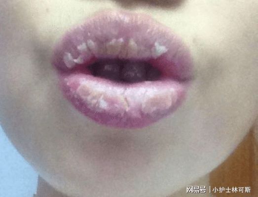 龍魚嘴巴都脫皮怎么回事（龍魚嘴巴脫皮怎么回事）